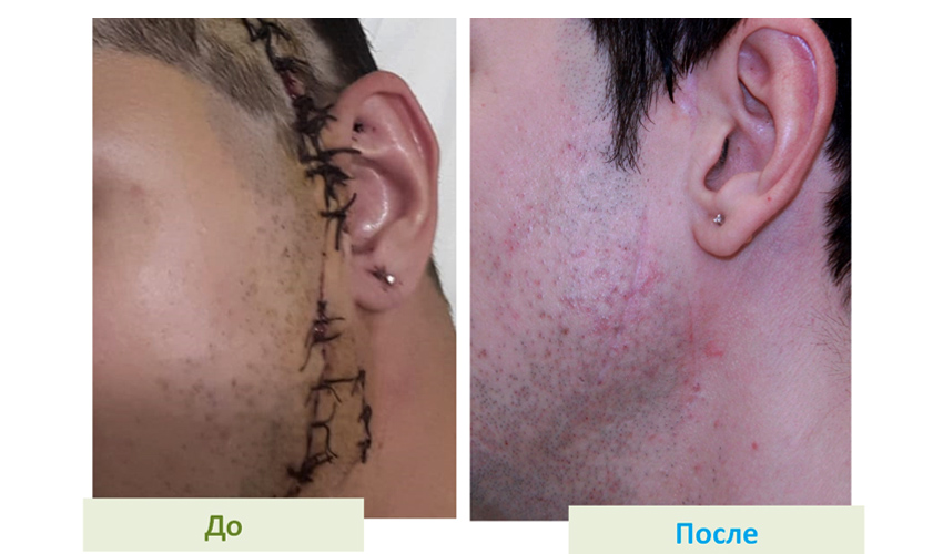 Жизнь без рубцов